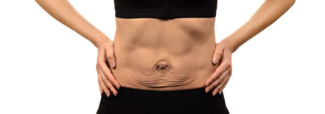 Diastasis Recti after Pregnancy- Symptoms and How to Recover - Sweet Skin  Liners