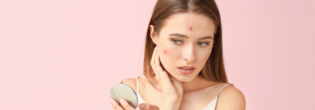 Pregnancy Acne Causes Prevention And Treatment Healthy Pregnancy