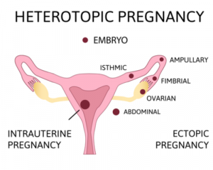 Heterotopic Pregnancy: What to Know 1